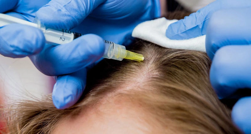 مزوتراپی صورت